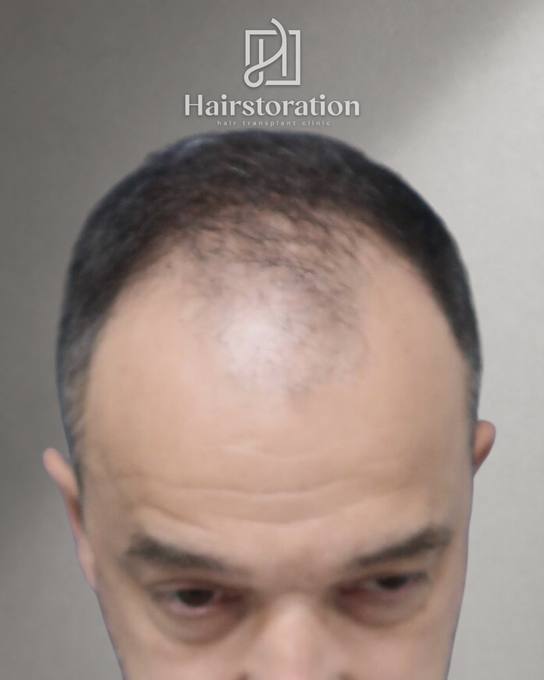 HS-021 before
